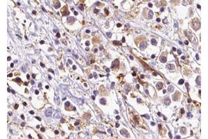 ABIN6273603 at 1/100 staining Human breast cancer tissue by IHC-P. (SLC35C2 anticorps  (C-Term))