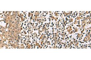 Immunohistochemistry of paraffin-embedded Human tonsil tissue using DCAF12 Polyclonal Antibody at dilution of 1:65(x200) (DCAF12 anticorps)