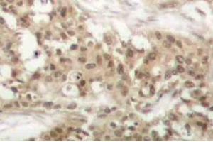 Immunohistochemistry (IHC) analyzes of p-PKC theta antibody in paraffin-embedded human breast carcinoma tissue. (PKC theta anticorps  (pSer676))