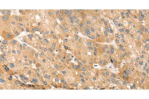 Immunohistochemistry of paraffin-embedded Human liver cancer using EVA1A Polyclonal Antibody at dilution of 1:30 (TMEM166 anticorps)