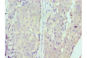 Immunohistochemistry of paraffin-embedded human colon cancer using ABIN7150341 at dilution of 1:100 (MCM7 anticorps  (AA 360-719))