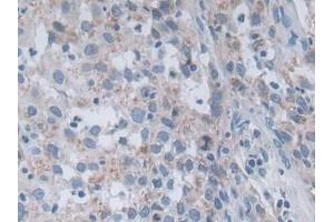 Detection of OAT in Human Lung cancer Tissue using Polyclonal Antibody to Ornithine Aminotransferase (OAT)