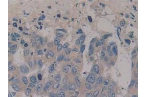 Detection of NPY in Human Breast cancer Tissue using Polyclonal Antibody to Neuropeptide Y (NPY)