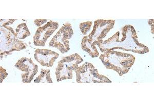 Immunohistochemistry of paraffin-embedded Human thyroid cancer tissue using ABCD1 Polyclonal Antibody at dilution of 1:80(x200) (ABCD1 anticorps)