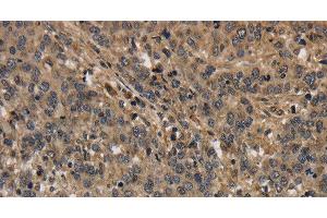 Immunohistochemistry of paraffin-embedded Human liver cancer using KCNN4 Polyclonal Antibody at dilution of 1:40 (KCNN4 anticorps)