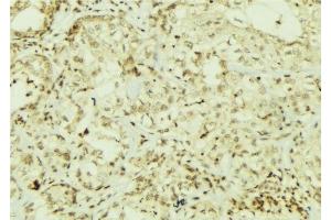ABIN6267064 at 1/100 staining Human breast cancer tissue by IHC-P. (AKT 1/2/3 anticorps  (pTyr312, pTyr315, pTyr316))