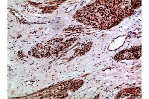 Immunohistochemical analysis of paraffin-embedded human-cervical-cancer, antibody was diluted at 1:200 (Thymopoietin anticorps  (AA 1-50))