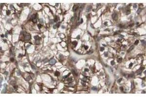 Affinity Purified anti-MAD2L2 antibody shows strong nuclear and cytoplasmic staining of tumor cells in cancerous human kidney tissue. (MAD2L2 anticorps  (N-Term))