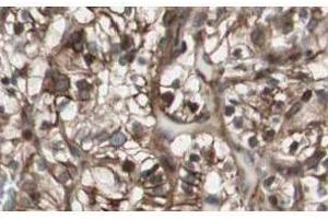 Affinity Purified anti-MAD2L2 antibody shows strong nuclear and cytoplasmic staining of tumor cells in cancerous human kidney tissue. (MAD2L2 anticorps  (AA 3-14))