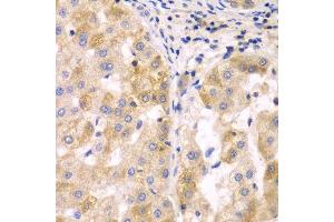 Immunohistochemistry of paraffin-embedded human liver cancer using SULT2B1 antibody. (SULT2B1 anticorps  (AA 1-365))