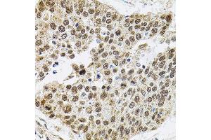 Immunohistochemistry of paraffin-embedded human lung cancer using Smarcd1 antibody (ABIN6003658) (40x lens). (SMARCD1 anticorps)