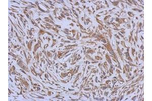IHC-P Image Immunohistochemical analysis of paraffin-embedded U373 xenograft, using ENTPD3, antibody at 1:500 dilution. (ENTPD3 anticorps)