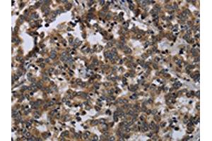 The image on the left is immunohistochemistry of paraffin-embedded Human liver cancer tissue using ABIN7129488(FGF18 Antibody) at dilution 1/20, on the right is treated with fusion protein.