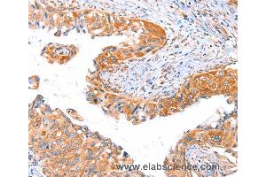 Immunohistochemistry of Human thyroid cancer using AP1B1 Polyclonal Antibody at dilution of 1:70