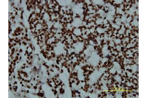 Immunoperoxidase of monoclonal antibody to POU2F2 on formalin-fixed paraffin-embedded human ovary, clear cell carcinoma tissue.
