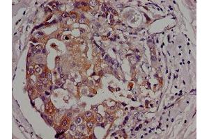 Immunohistochemistry of paraffin-embedded human breast cancer using ABIN7154605 at dilution of 1:100 (Adenylate Kinase 3 anticorps  (AA 142-227))