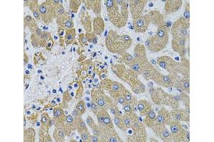Immunohistochemistry of paraffin-embedded Human liver damage using MBL2 Polyclonal Antibody (MBL2 anticorps)