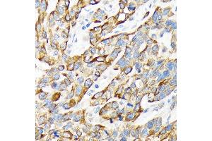 Immunohistochemistry of paraffin-embedded human esophageal cancer using Cytokeratin 16 (KRT16) Rabbit mAb (ABIN7268094) at dilution of 1:100 (40x lens).