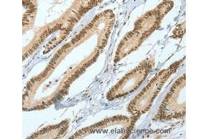 Immunohistochemistry of Human liver cancer using ASH2L Polyclonal Antibody at dilution of 1:50 (ASH2L anticorps)