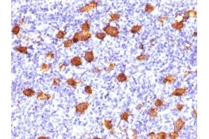 Formalin-fixed, paraffin-embedded human Hodgkin's Lymphoma stained with CD30 Rabbit Polyclonal Antibody. (TNFRSF8 anticorps)