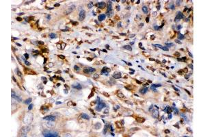 Anti- TAP1 Picoband antibody, IHC(P) IHC(P): Human Intestinal Cancer Tissue (TAP1 anticorps  (Middle Region))