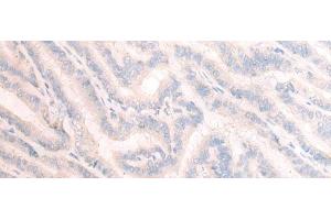 Immunohistochemistry of paraffin-embedded Human thyroid cancer tissue using TBC1D2 Polyclonal Antibody at dilution of 1:25(x200) (TBC1D2 anticorps)