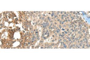 Immunohistochemistry of paraffin-embedded Human liver cancer tissue using MAPK4 Polyclonal Antibody at dilution of 1:35(x200) (MAPK4 anticorps)