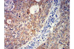 Immunohistochemical analysis of paraffin-embedded stomach cancer tissues using GRM5 mouse mAb with DAB staining. (Metabotropic Glutamate Receptor 5 anticorps  (AA 458-580))