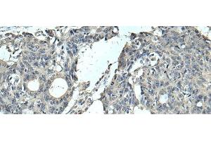 Immunohistochemistry of paraffin-embedded Human colorectal cancer tissue using SLC35F6 Polyclonal Antibody at dilution of 1:95(x200) (SLC35F6 anticorps)