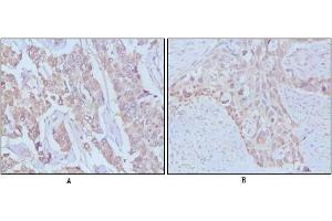 Immunohistochemical analysis of paraffin-embedded human breast cancer,Lung breast tissues using EGF antibody (EGF anticorps)