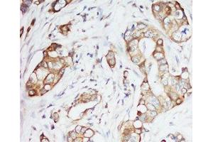 IHC-P: IGF-1 antibody testing of human breast cancer tissue (IGF1 anticorps  (Middle Region))
