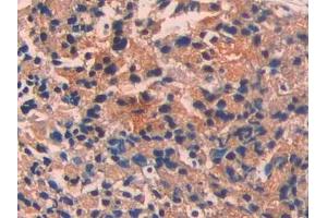 DAB staining on IHC-P; Samples: Human Prostate cancer Tissue
