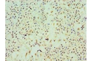 Immunohistochemistry of paraffin-embedded human breast cancer using ABIN7172211 at dilution of 1:100 (TFPI2 anticorps  (AA 23-235))