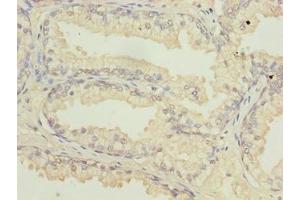 Immunohistochemistry of paraffin-embedded human prostate cancer using ABIN7144813 at dilution of 1:100 (ATL2 anticorps  (AA 1-300))