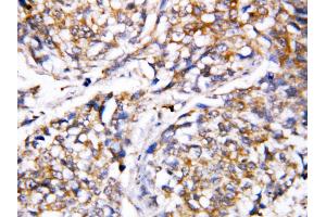 Anti-Caspase 4 antibody, IHC(P) IHC(P): Human Mammary Cancer Tissue (Caspase 4 anticorps  (N-Term))