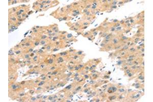 The image on the left is immunohistochemistry of paraffin-embedded Human liver cancer tissue using ABIN7192841(TNK1 Antibody) at dilution 1/20, on the right is treated with synthetic peptide.
