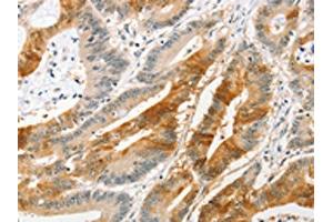 The image on the left is immunohistochemistry of paraffin-embedded Human colon cancer tissue using ABIN7128400(ANAPC2 Antibody) at dilution 1/20, on the right is treated with fusion protein.