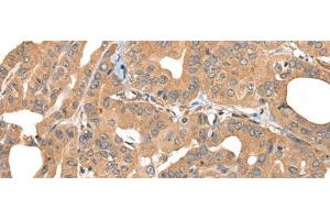 Immunohistochemistry of paraffin-embedded Human thyroid cancer tissue using PPP3R1 Polyclonal Antibody at dilution of 1:55(x200)
