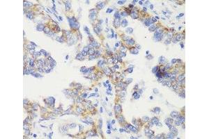Immunohistochemistry of paraffin-embedded Human lung cancer using TOM20 Polyclonal Antibody at dilution of 1:100 (40x lens).