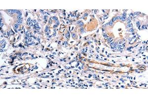 Immunohistochemistry of paraffin-embedded Human stomach cancer using COX11 Polyclonal Antibody at dilution of 1:30 (COX11 anticorps)