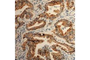 Immunohistochemical analysis of CD49b staining in human colon cancer formalin fixed paraffin embedded tissue section.