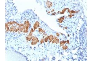 IHC testing of FFPE human breast tissue with recombinant SMMHC antibody (clone MYH11/2303R). (MYH11 anticorps)