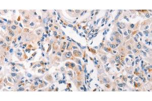 Immunohistochemistry of paraffin-embedded Human liver cancer tissue using MUC2 Polyclonal Antibody at dilution 1:60