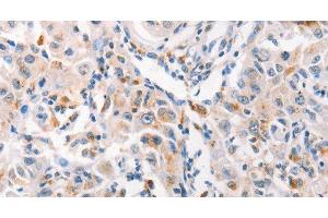 Immunohistochemistry of paraffin-embedded Human liver cancer tissue using MUC2 Polyclonal Antibody at dilution 1:60 (MUC2 anticorps)