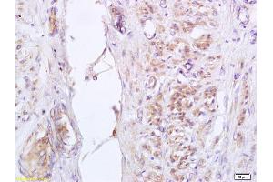 Formalin-fixed and paraffin embedded human cervical carcinoma labeled with Anti-phospho-GADD153 (Ser30) Polyclonal Antibody, Unconjugated (ABIN755977) at 1:200 followed by conjugation to the secondary antibody and DAB staining (DDIT3 anticorps  (pSer30))