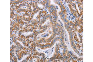 Immunohistochemistry of Human cervical cancer using BST1 Polyclonal Antibody at dilution of 1:50 (BST1 anticorps)