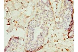 Immunohistochemistry of paraffin-embedded human breast cancer using ABIN7172240 at dilution of 1:100 (TRAF4 anticorps  (AA 251-470))