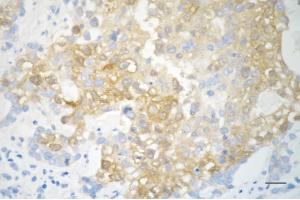 Immunohistochemistry was performed on paraffin-embedded human breast carcinoma using phospho-ACC(S79) antibody (ABIN7797443), 1:200).