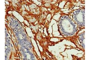 Immunohistochemistry of paraffin-embedded human breast cancer using ABIN7153601 at dilution of 1:100