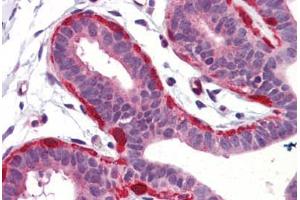 Human Breast (formalin-fixed, paraffin-embedded) stained with SNCG antibody ABIN364362 at 5 ug/ml followed by biotinylated goat anti-rabbit IgG secondary antibody ABIN481713, alkaline phosphatase-streptavidin and chromogen. (SNCG anticorps)